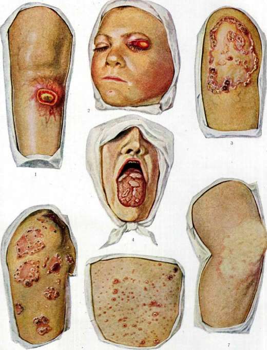 Syphilis: figure 5 from the 1928–1936 encyclopedia article