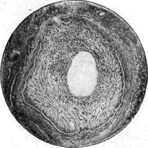 Syphilis: figure 7 from the 1928–1936 encyclopedia article