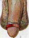 Syphilis: figure 2 from the 1928–1936 encyclopedia article