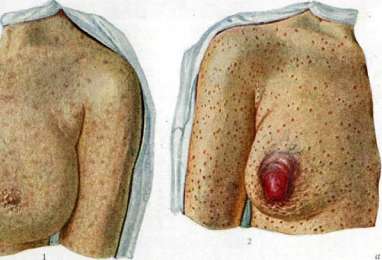 Syphilis: figure 1 from the 1928–1936 encyclopedia article
