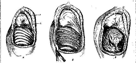 Thoracoplasty: figure 19 from the 1928–1936 encyclopedia article