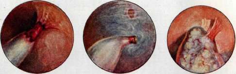 Thoracoplasty: figure 24 from the 1928–1936 encyclopedia article