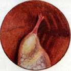 Thoracoplasty: figure 21 from the 1928–1936 encyclopedia article