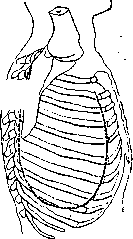 Thoracoplasty: figure 6 from the 1928–1936 encyclopedia article