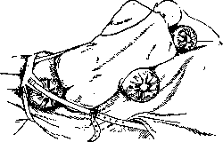 Thoracoplasty: figure 7 from the 1928–1936 encyclopedia article