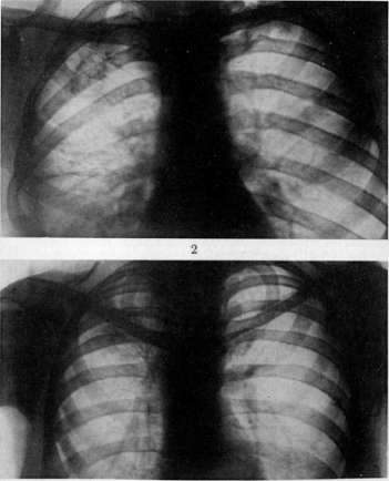 Thoracoplasty: figure 3 from the 1928–1936 encyclopedia article