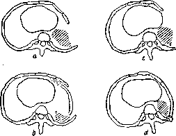 Thoracoplasty: figure 1 from the 1928–1936 encyclopedia article