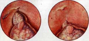 Thoracoplasty: figure 20 from the 1928–1936 encyclopedia article