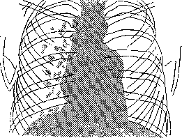 Thoracoscopy: figure 5 from the 1928–1936 encyclopedia article