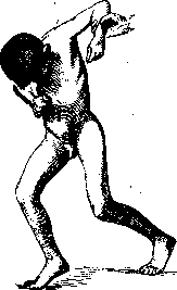Torsion Spasm: figure 2 from the 1928–1936 encyclopedia article