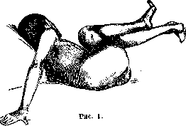 Torsion Spasm: figure 1 from the 1928–1936 encyclopedia article