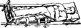 Splints: figure 10 from the 1928–1936 encyclopedia article