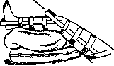 Splints: figure 9 from the 1928–1936 encyclopedia article