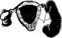 Haematometra: figure 1 from the 1928–1936 encyclopedia article