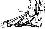 Hallux Valgus: figure 2 from the 1928–1936 encyclopedia article