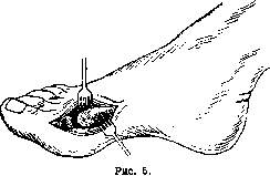 Hallux Valgus: figure 6 from the 1928–1936 encyclopedia article