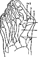 Hallux Valgus: figure 1 from the 1928–1936 encyclopedia article