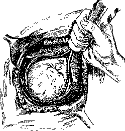 Cesarean Section: figure 5 from the 1928–1936 encyclopedia article