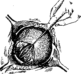Cesarean Section: figure 4 from the 1928–1936 encyclopedia article