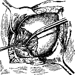 Cesarean Section: figure 3 from the 1928–1936 encyclopedia article