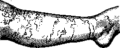 Larva Migrans: figure 2 from the 1928–1936 encyclopedia article
