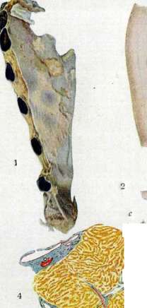 Pemphigus: figure 1 from the 1928–1936 encyclopedia article