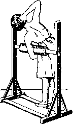 Scoliosis: figure 7 from the 1928–1936 encyclopedia article