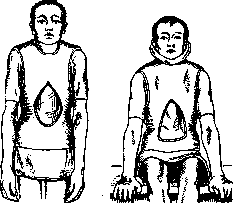 Plaster Casts, Corsets, and Beds: figure 3 from the 1928–1936 encyclopedia article