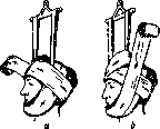 Plaster Casts, Corsets, and Beds: figure 6 from the 1928–1936 encyclopedia article