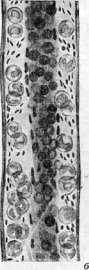 Thrombus: figure 3 from the 1928–1936 encyclopedia article