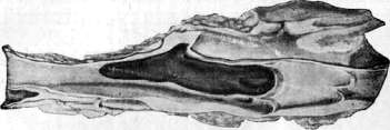 Thrombus: figure 1 from the 1928–1936 encyclopedia article