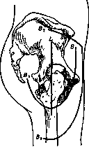 Arthrotomy: figure 2 from the 1928–1936 encyclopedia article