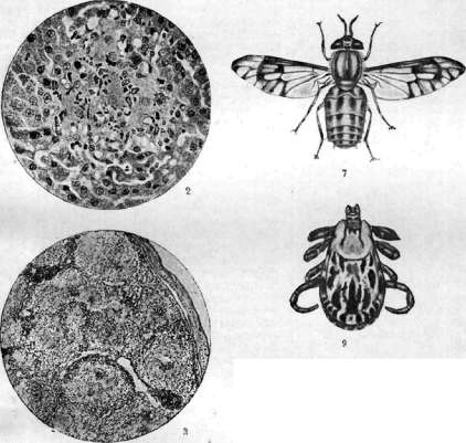 Tularemia: figure 3 from the 1928–1936 encyclopedia article