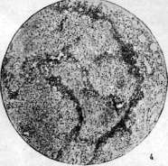 Tularemia: figure 6 from the 1928–1936 encyclopedia article