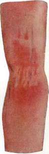 Dermatoses: figure 2 from the 1928–1936 encyclopedia article