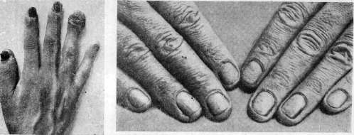 Onychia: figure 4 from the 1928–1936 encyclopedia article