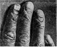 Onychia: figure 2 from the 1928–1936 encyclopedia article