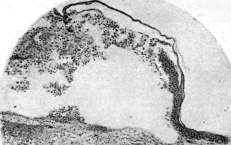 Sarcoma: figure 1 from the 1928–1936 encyclopedia article