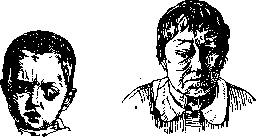 Exophthalmos: figure 1 from the 1928–1936 encyclopedia article