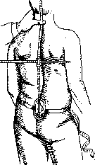 Scoliosometer: figure 1 from the 1928–1936 encyclopedia article