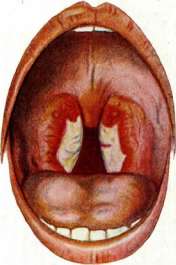 Diphtheritis: figure 9 from the 1928–1936 encyclopedia article