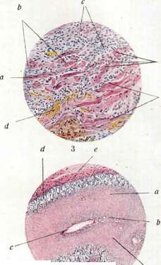 Diphtheritis: figure 8 from the 1928–1936 encyclopedia article