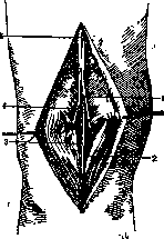 Stoffel Operation: figure 3 from the 1928–1936 encyclopedia article