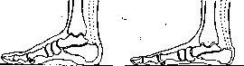 Flatfoot: figure 1 from the 1928–1936 encyclopedia article