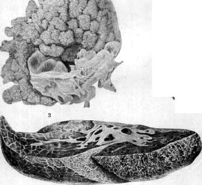Cancer: figure 5 from the 1928–1936 encyclopedia article