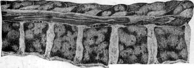 Cancer: figure 7 from the 1928–1936 encyclopedia article