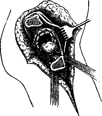 Arthroplasty: figure 2 from the 1928–1936 encyclopedia article