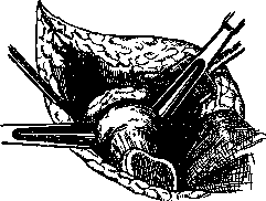 Arthroplasty: figure 1 from the 1928–1936 encyclopedia article