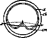 Deutschmann's Operation: figure 2 from the 1928–1936 encyclopedia article