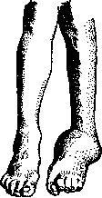 Arthropathy: figure 1 from the 1928–1936 encyclopedia article